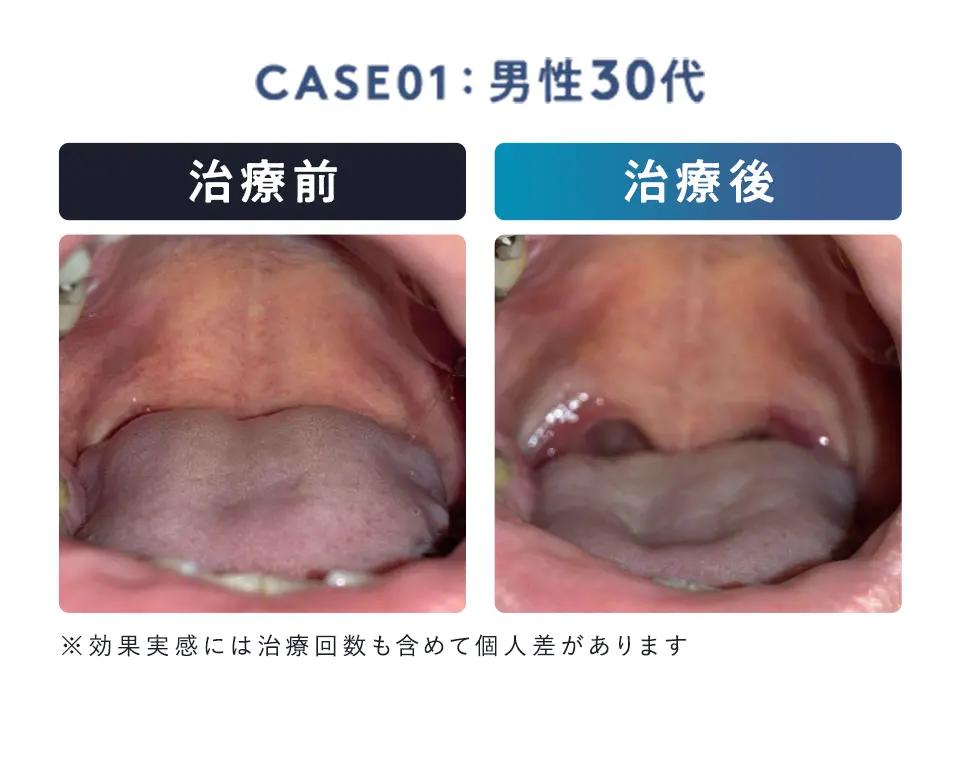 男性30代、治療前後の口内