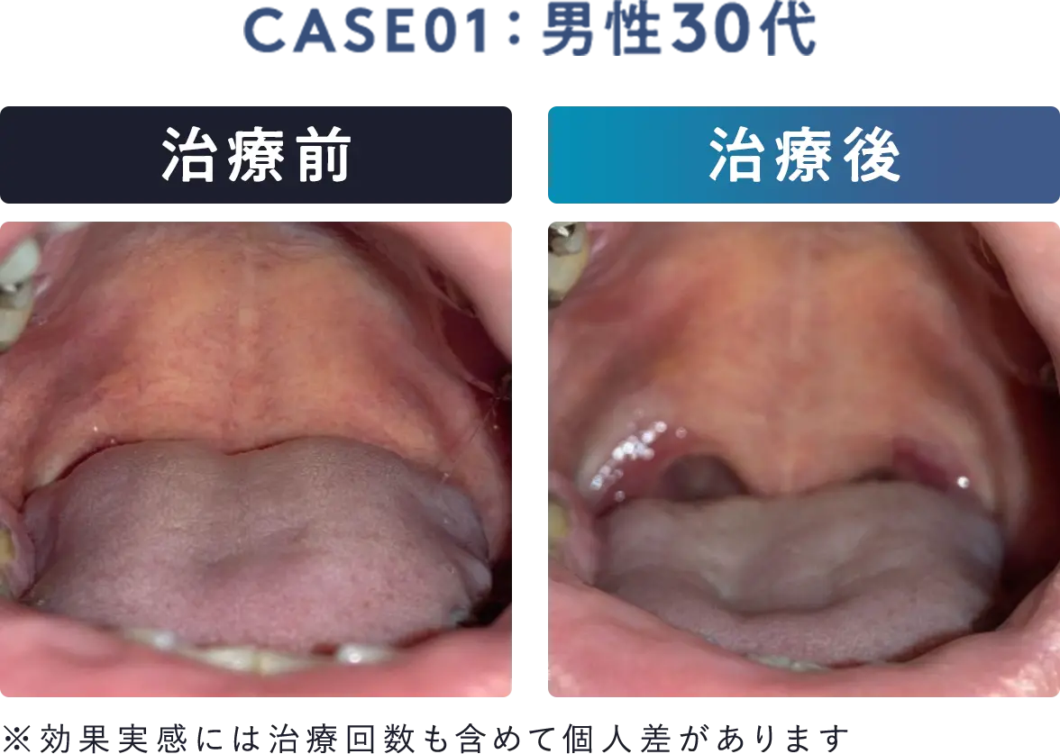 男性30代、治療前後の口内