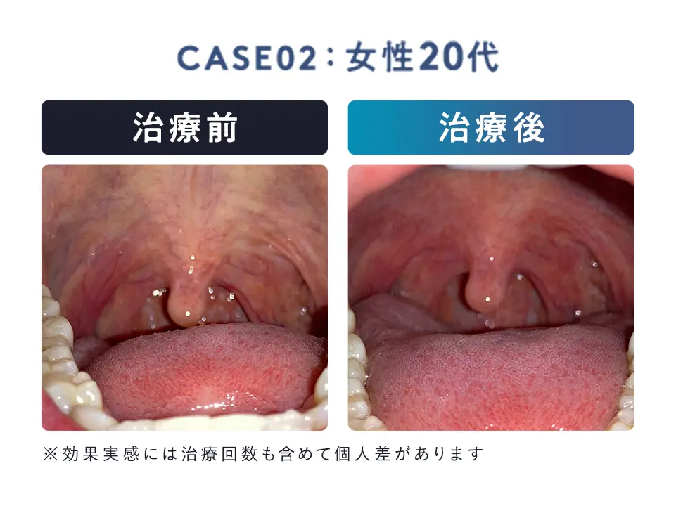 女性20代、治療前後の口内