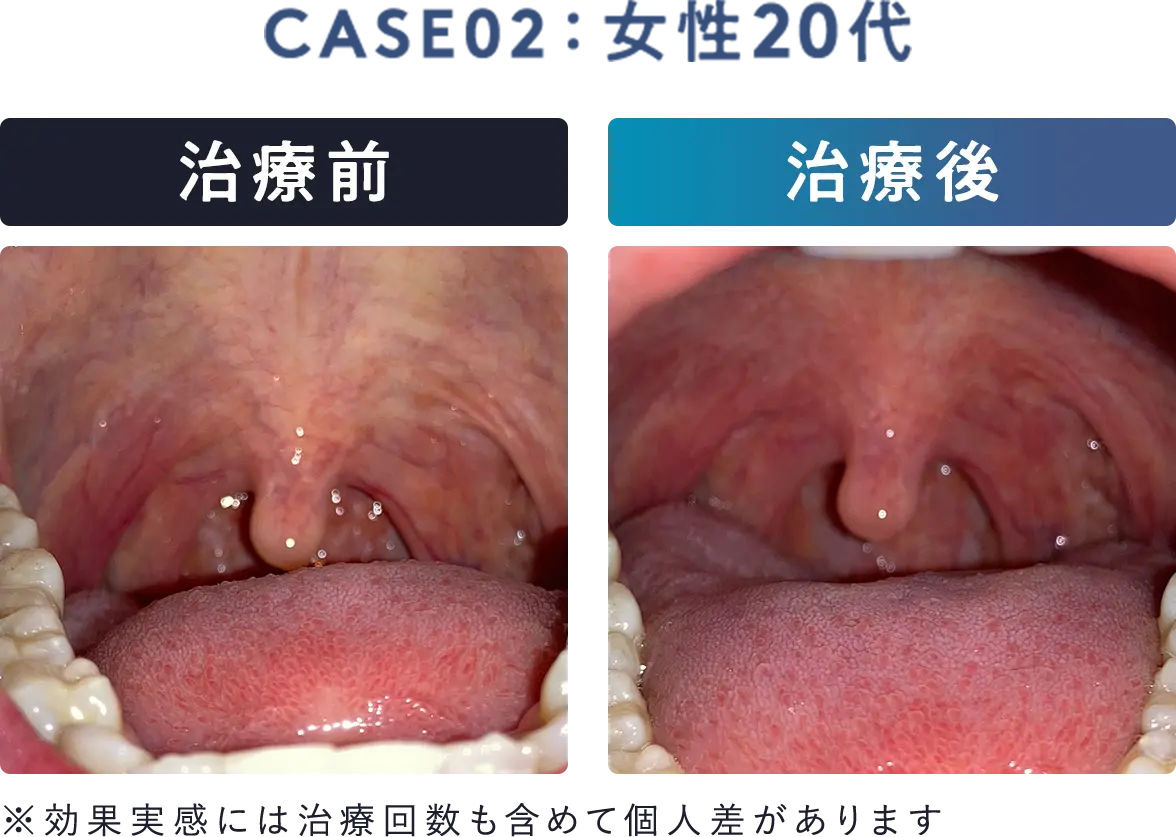 女性20代、治療前後の口内