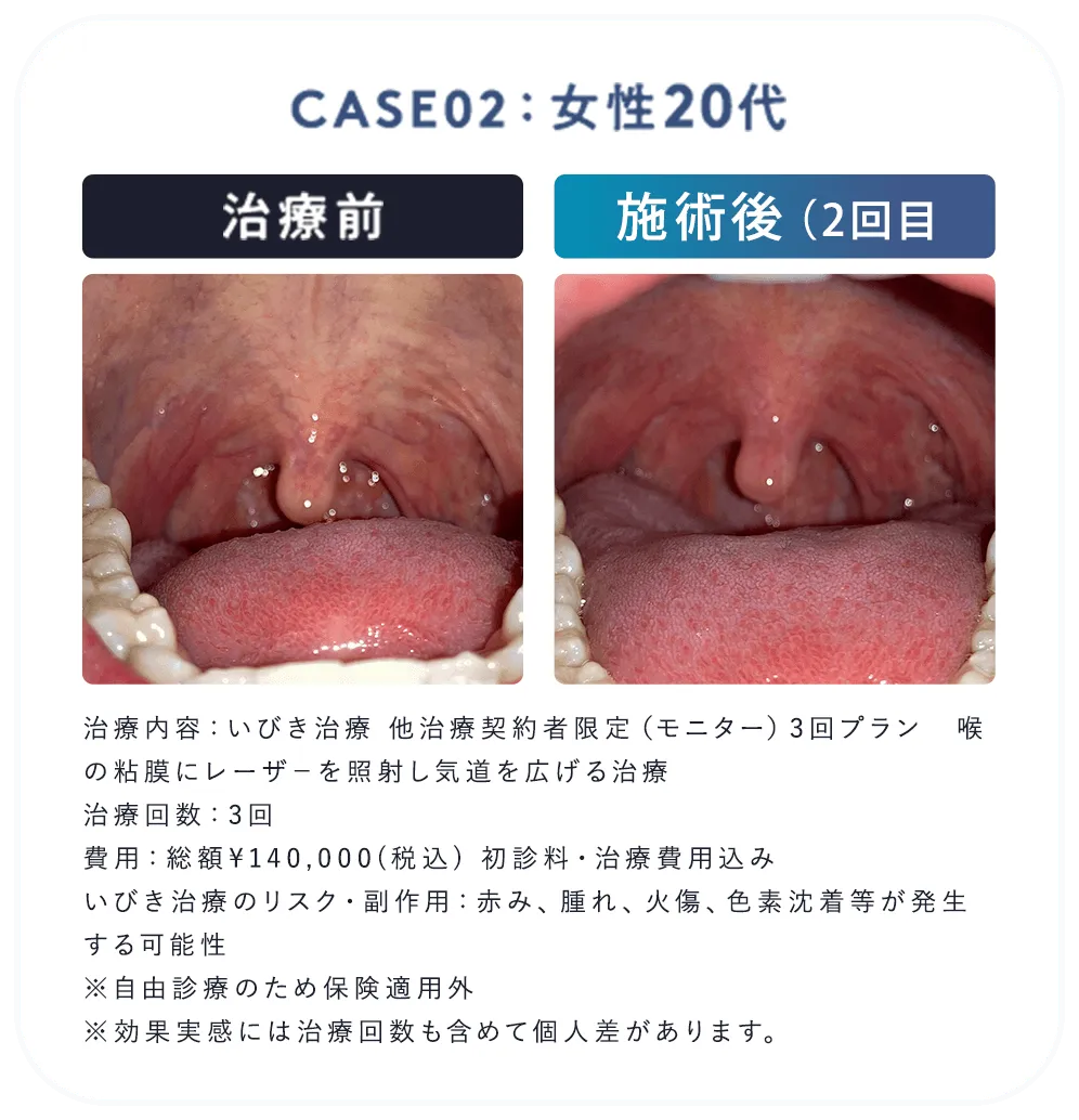女性20代、治療前後の口内