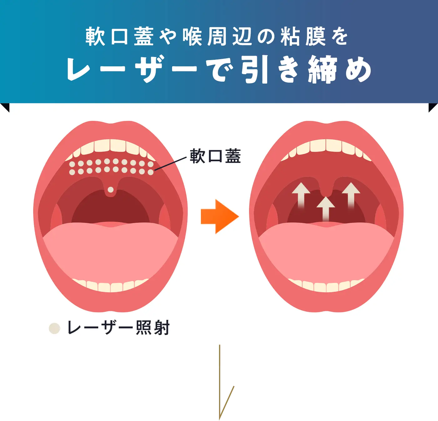 軟口蓋や喉周辺の粘膜をレーザーで引き締め
